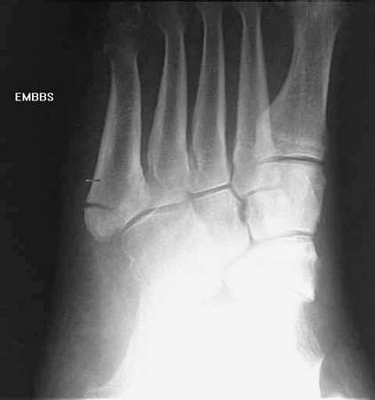 Dancer's fracture, AP view , Oblique view , Lateral view 2