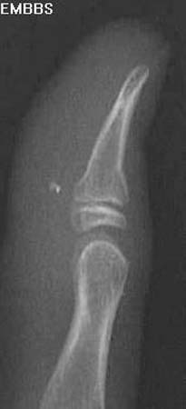 Distal phalanx of thumb torus fracture.