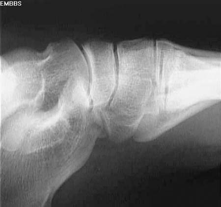 Fracture of cuboid, close up of oblique view