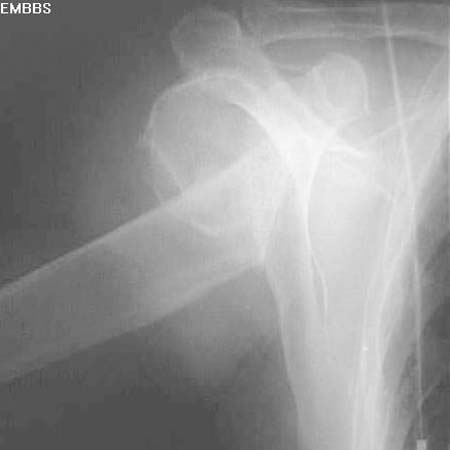 Humeral surgical neck fracture, displaced