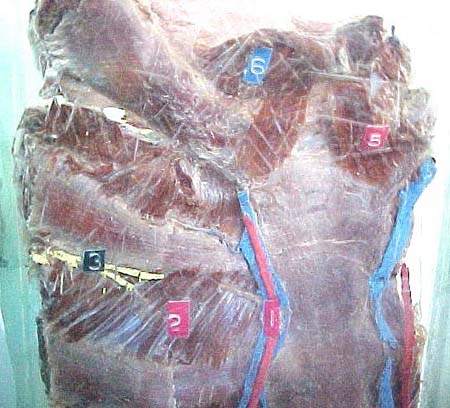 Chest wall 5a